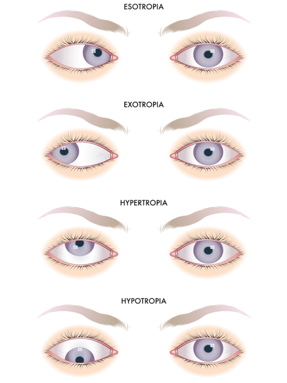 Non Surgical Eye Turns - Sunshine Vision Development Center