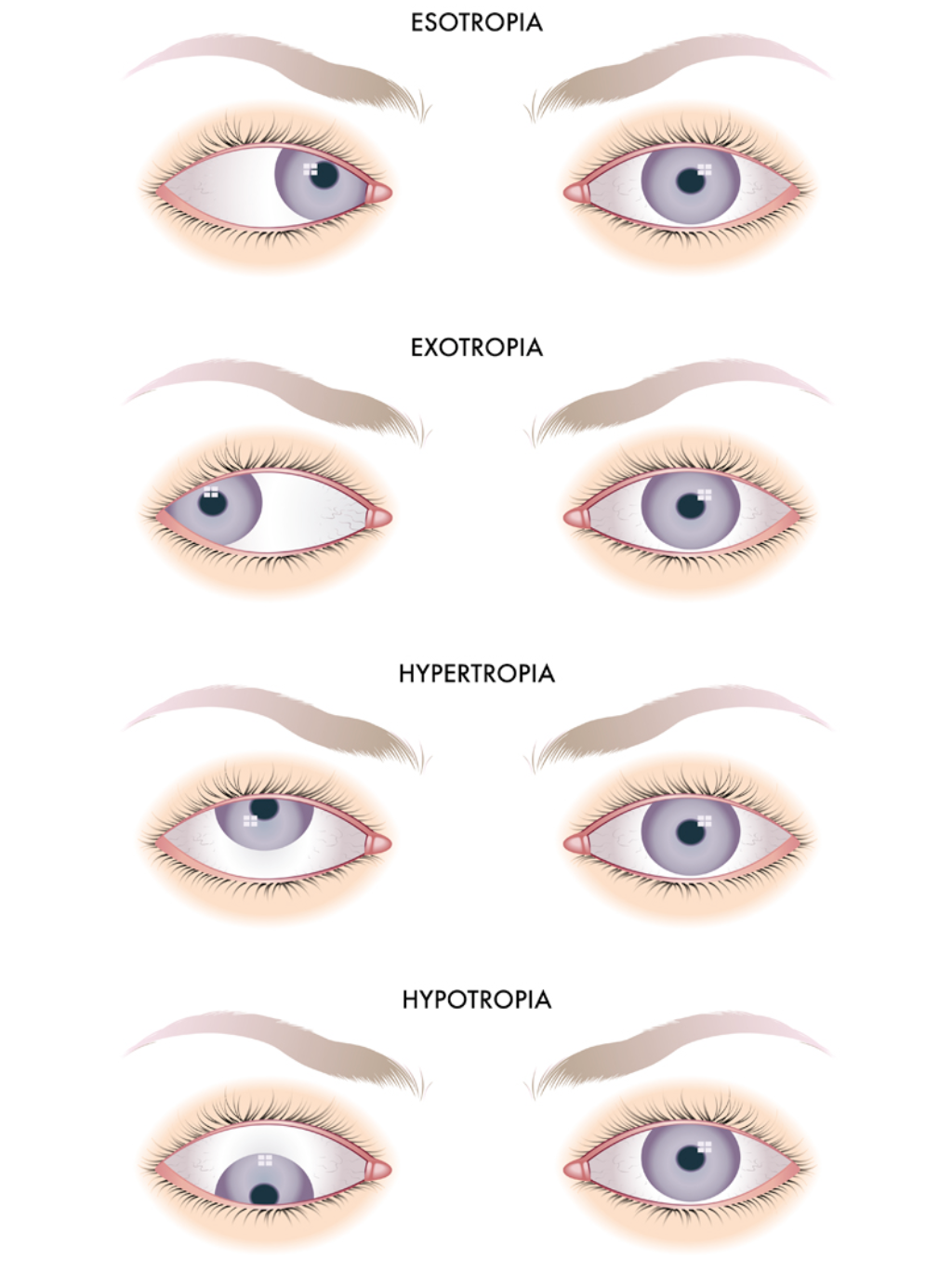 what-you-need-to-know-about-strabismus